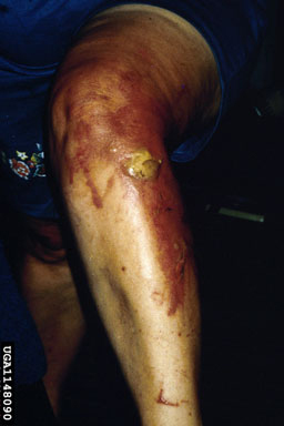 Burn caused by giant hogweed